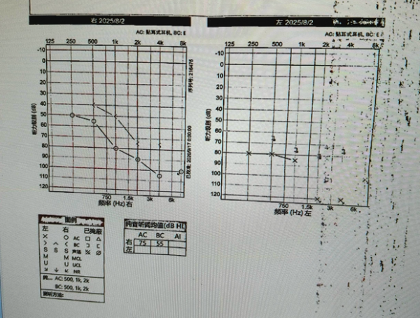 配资114平台查询 无声世界二十载，一朝手术获新声！耳鼻咽喉头颈专家夏瑞明教授成功实施人工耳蜗植入术